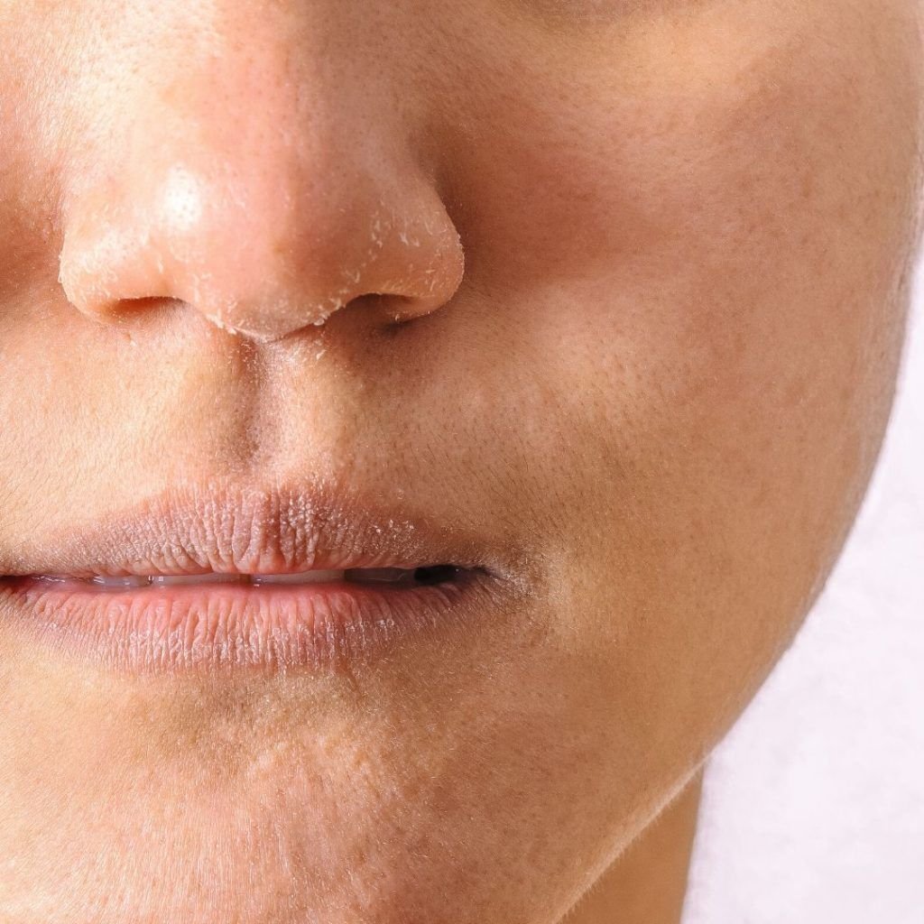 Dry skin